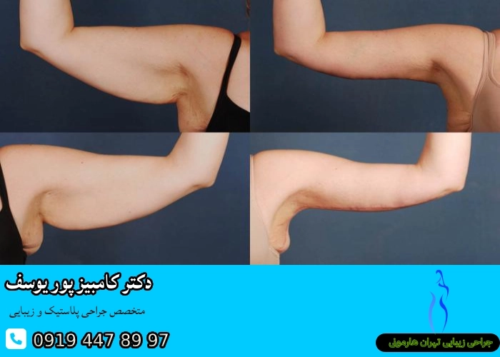 فرآیند لیفت بازو با لیزر توسط بهترین جراح براکیوپلاستی در تهران