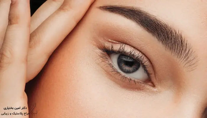 بلفاروپلاستی چشم گربه ای