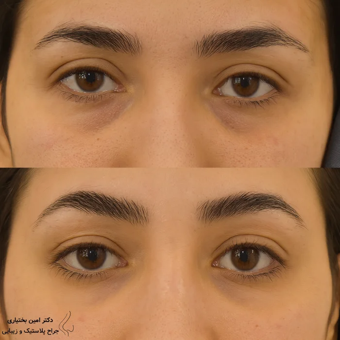 قبل و بعد از جراحی بلفاروپلاستی طبیعی توسط دکتر امین بختیاری در تهران