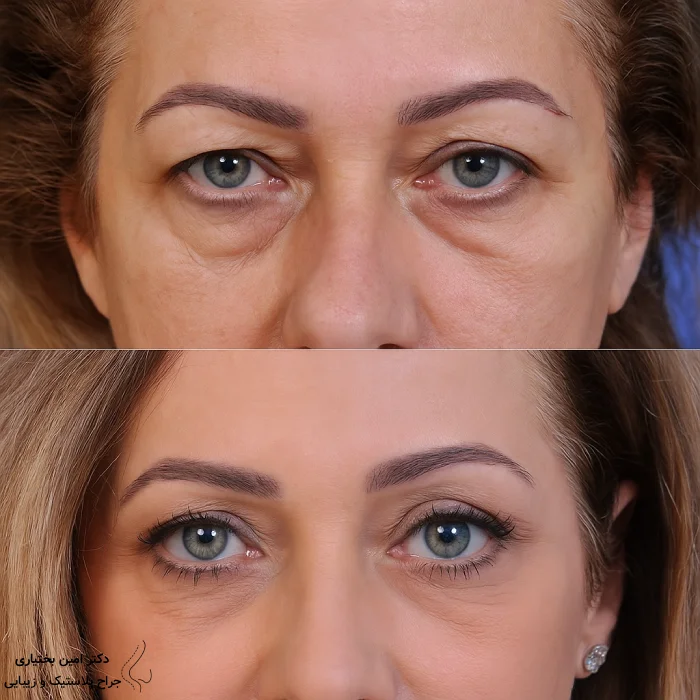 بهبود پف زیر چشم پس از جراحی بلفاروپلاستی توسط دکتر بختیاری