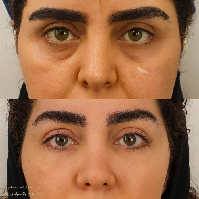 نمونه‌کار جراحی بلفاروپلاستی دکتر امین بختیاری در تهران - اصلاح افتادگی پلک بالا