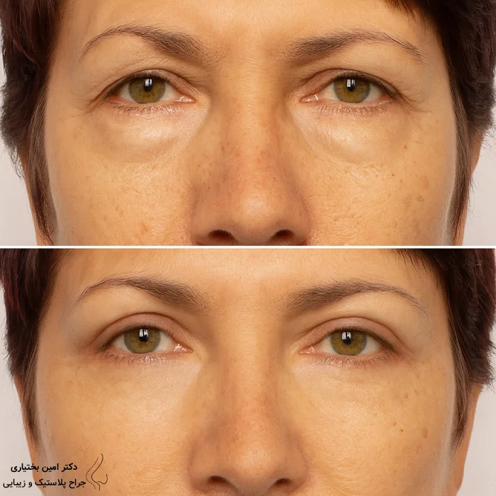 نتیجه واقعی عمل بلفاروپلاستی توسط دکتر امین بختیاری - پلک بالا و پایین
