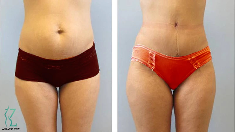 نمونه واقعی جراحی زیبایی شکم و سفت‌سازی عضلات | بهترین جراح ابدومینوپلاستی تهران