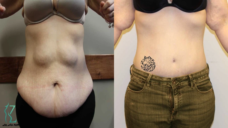 روند تغییر شکم قبل و بعد از ابدومینوپلاستی توسط بهترین جراح ابدومینوپلاستی در تهران