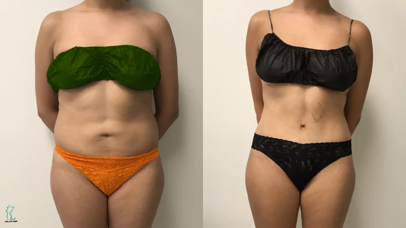 قبل و بعد جراحی شکم و پهلو | نمونه‌کار واقعی بهترین جراح ابدومینوپلاستی در تهران