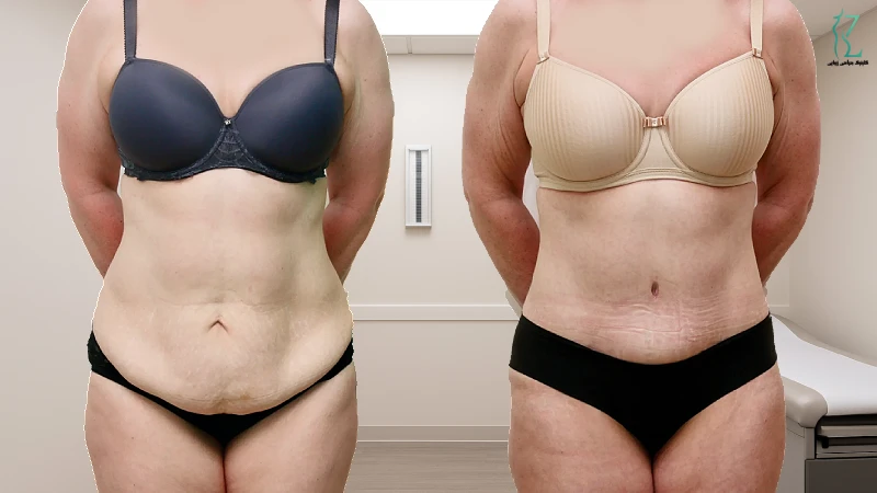 نمونه کار ابدومینوپلاستی شکم توسط دکتر بختیاری | بهترین جراح ابدومینوپلاستی در تهران