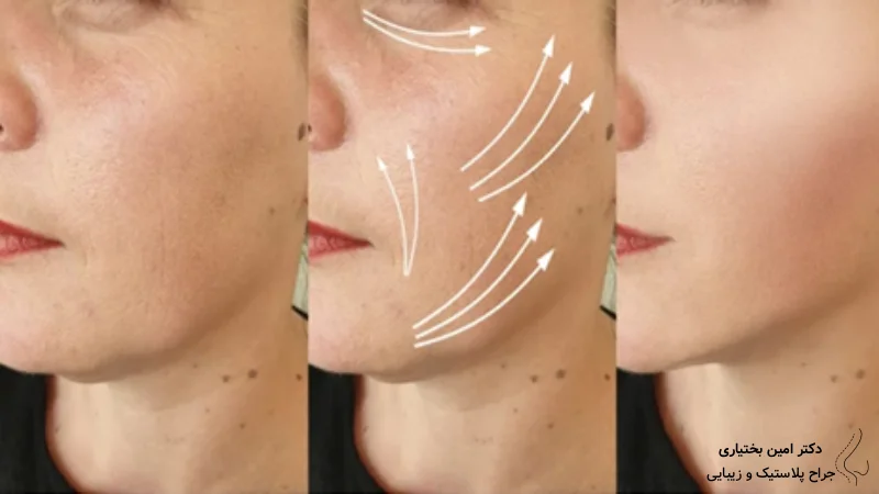 اندولیفت برای چه کسانی مناسب است؟