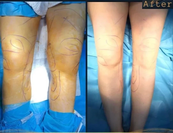 نمونه تخلیه چربی پا دکتر بختیاری