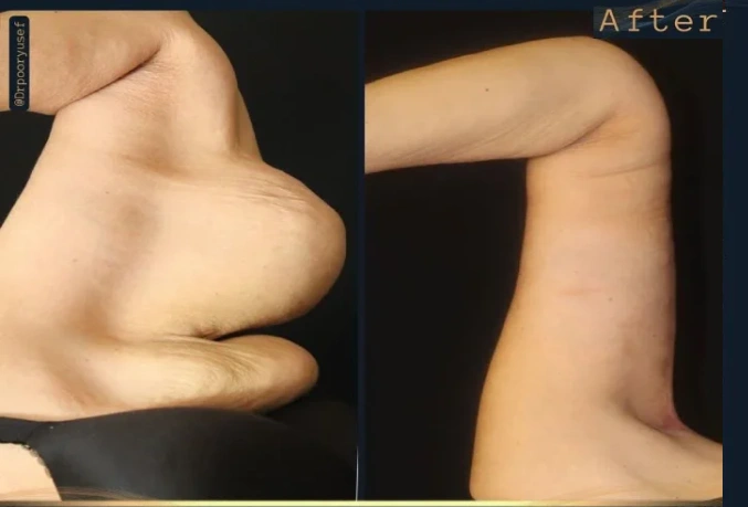 نمونه لیفت بازو دکتر بختیاری