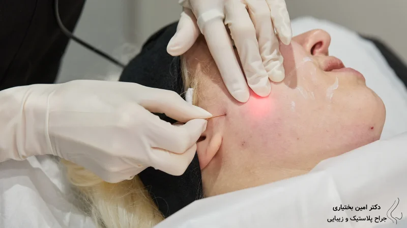 مزایا، نتایج و کاربردهای اندولیفت برای لیفت و جوانسازی صورت