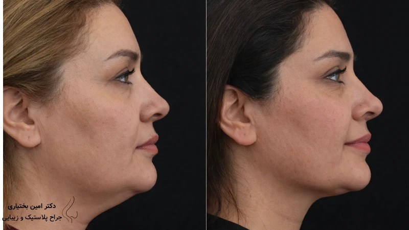 بهترین جراح اندولیفت صورت در تهران