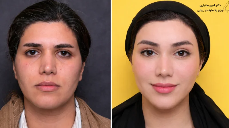 بهترین جراح اندولیفت صورت در تهران