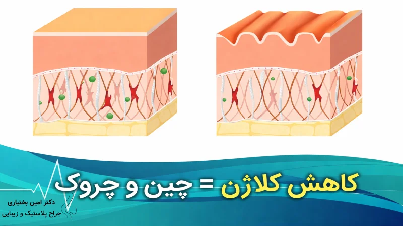 مراحل انجام اندولیفت صورت چگونه است؟