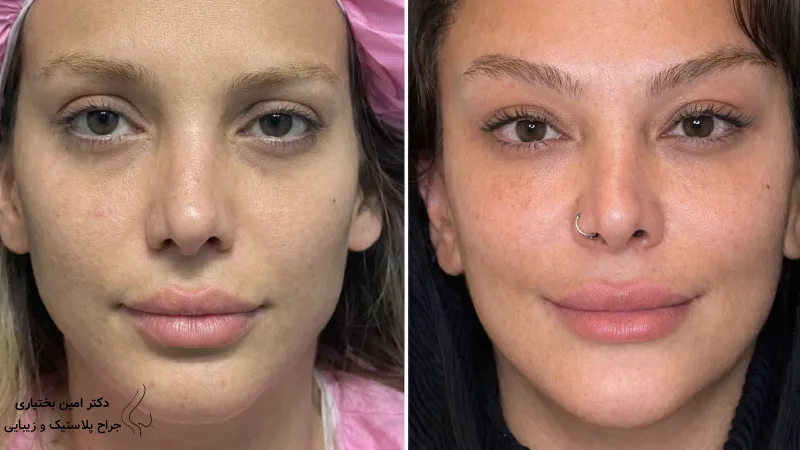 چرا انتخاب بهترین جراح اندولیفت صورت اهمیت دارد؟