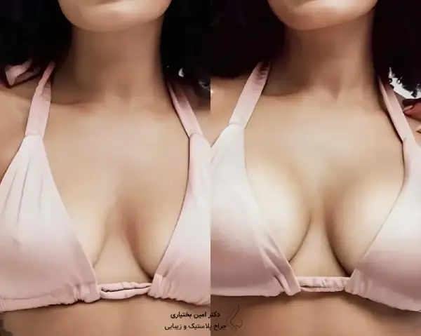 نمونه‌کار جراحی زیبایی و اصلاح فرم سینه دکتر امین بختیاری