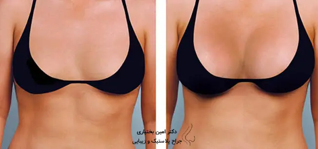 نمونه‌کار اصلاح افتادگی سینه توسط دکتر امین بختیاری در تهران